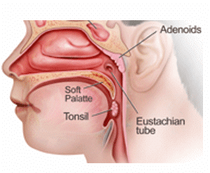 tonsillectomy scabs infected