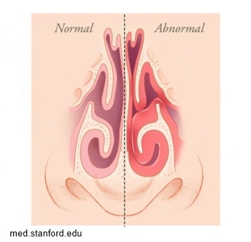 Septoplasty: Breathing Before, Swelling After, Results