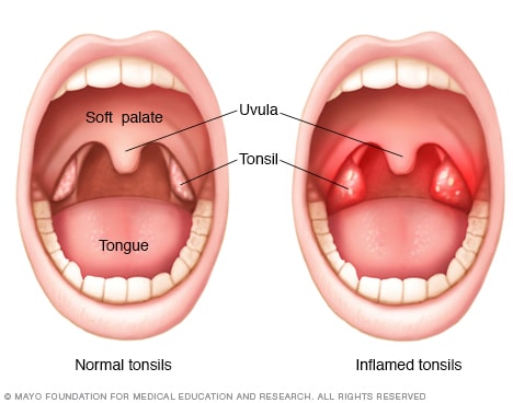 tonsillitis grading